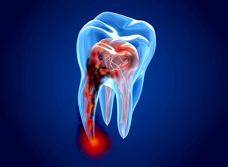terapia endodontica bologna